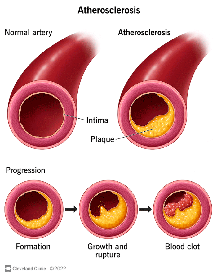 Top Foods To Solve Clogged Arteries