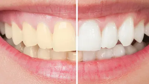 The Ultimate Guide To Teeth Whitening