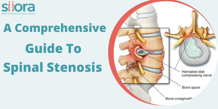 A Comprehensive Guide to Spinal Stenosis