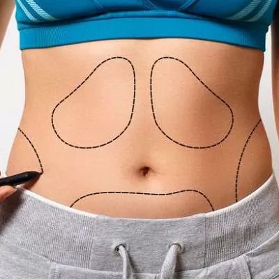 Tummy Tuck