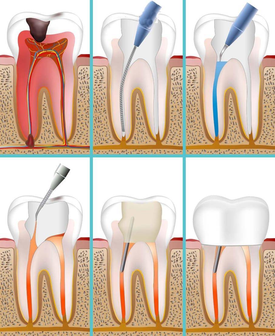 Burs and Endodontic Files Market Research Insights With
