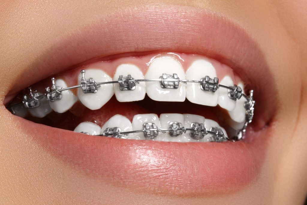 Different Types of Dental Braces in Dubai