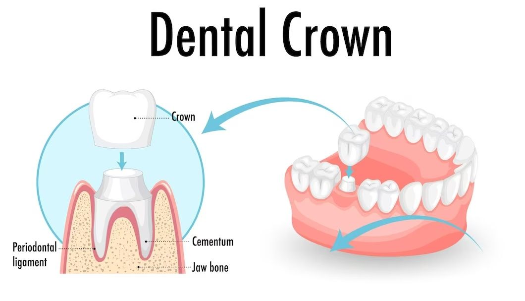 5 Benefits of Dental Crowns Enhancing Strength and Aesthetics