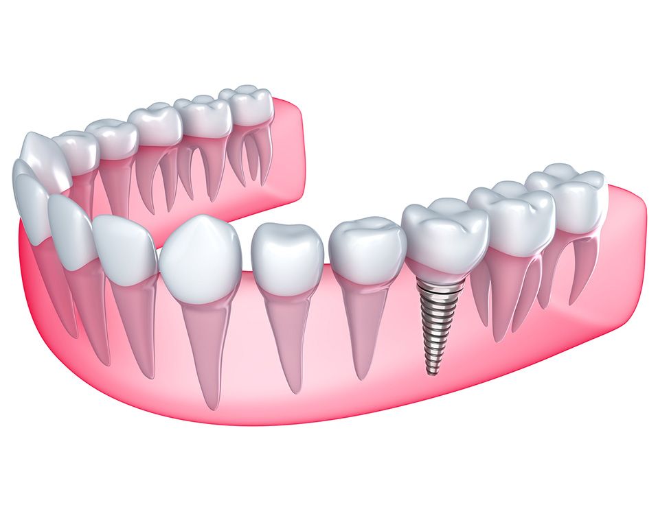 Dental Implants in Pakistan Cost, Procedure, and Benefits