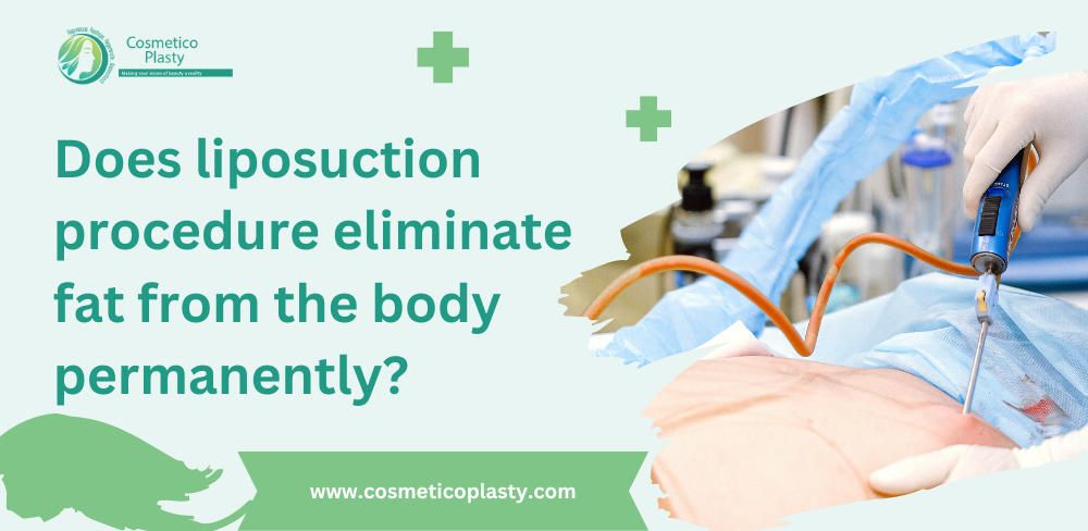 does-liposuction-procedure-eliminate-fat-from-body-permanently