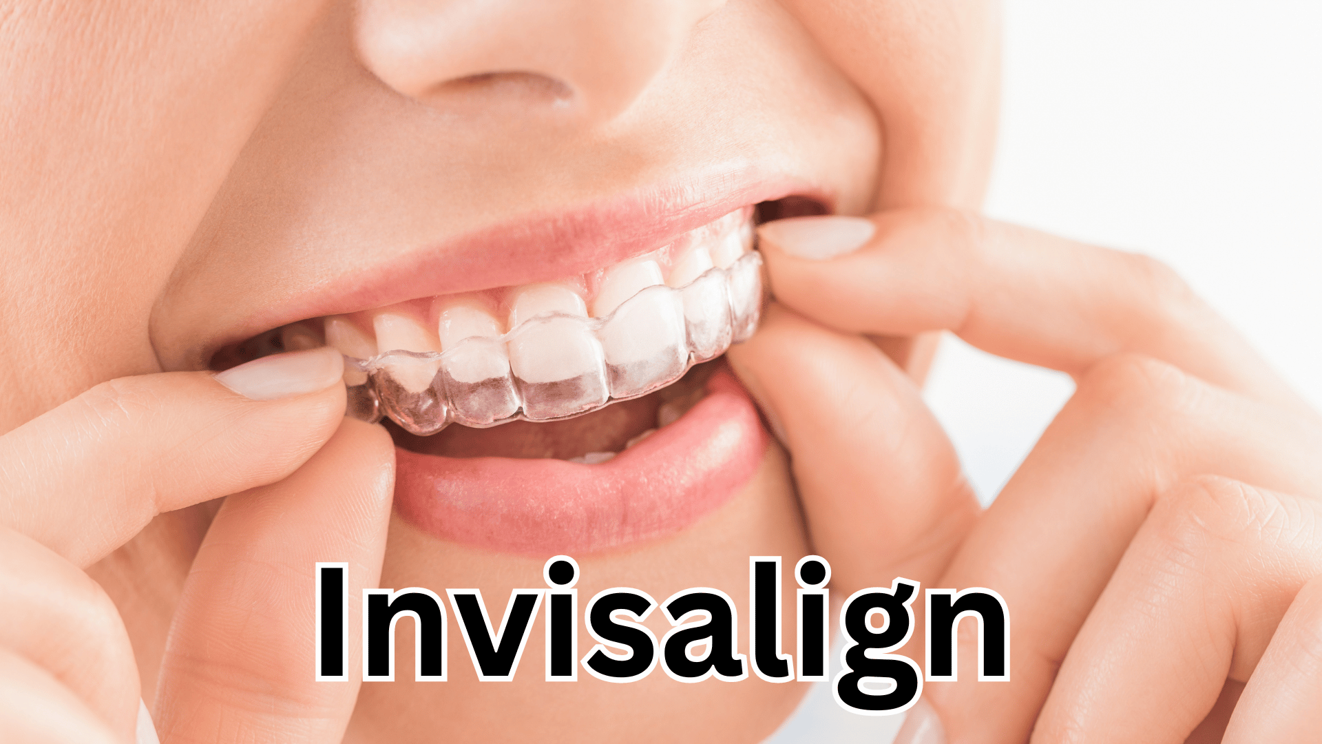 Orthodontic Treatment Choosing Between Invisalign and Braces