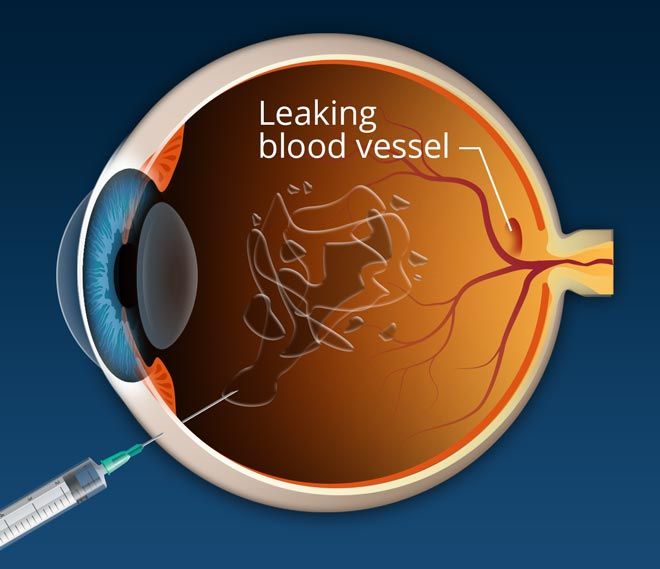 Macular Degeneration Treatment Market InDepth Analysis Report