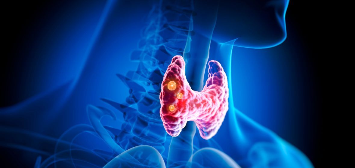 Thyroid Risks, Diagnoses, and Treatments