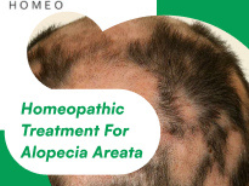 alopecia treatment through homeopathy