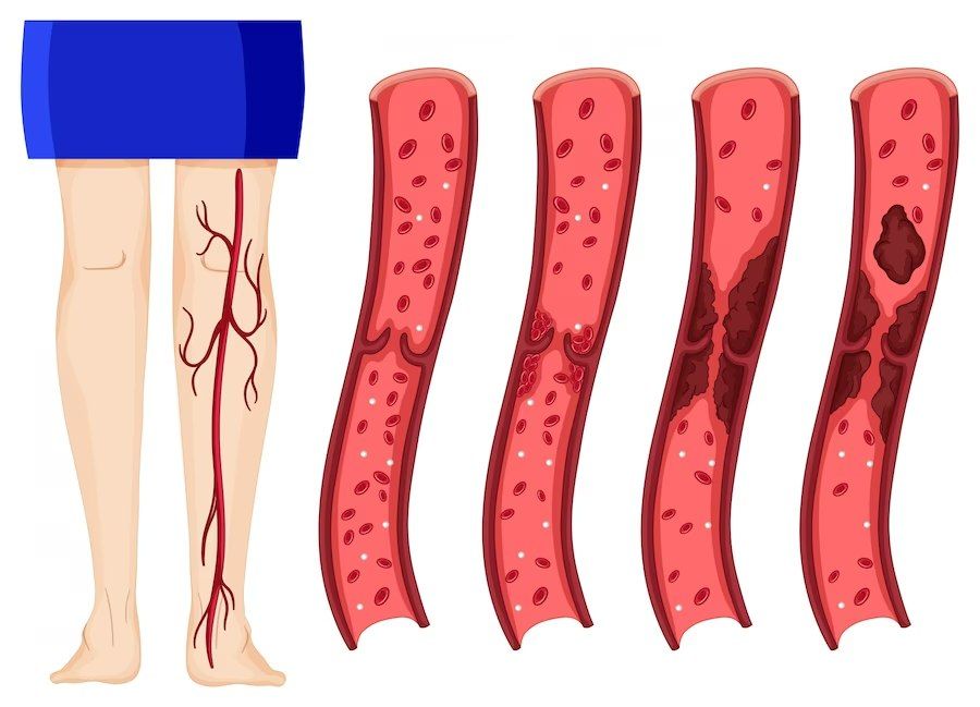 5 Ways To Reverse The Symptoms Of Venous Insufficiency 3665