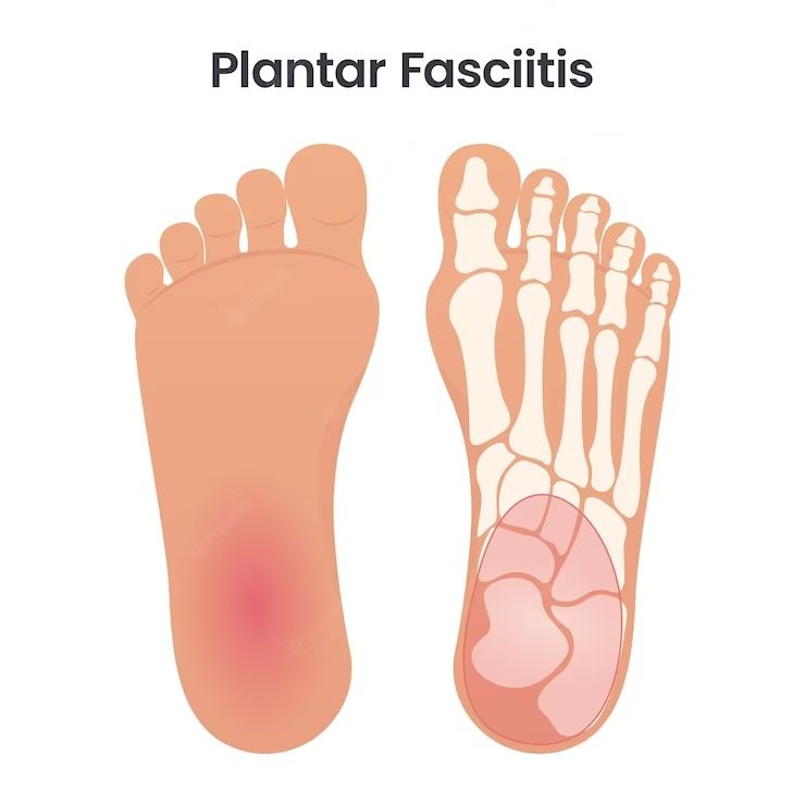 What Is Plantar Fasciitis and How Is It Caused?