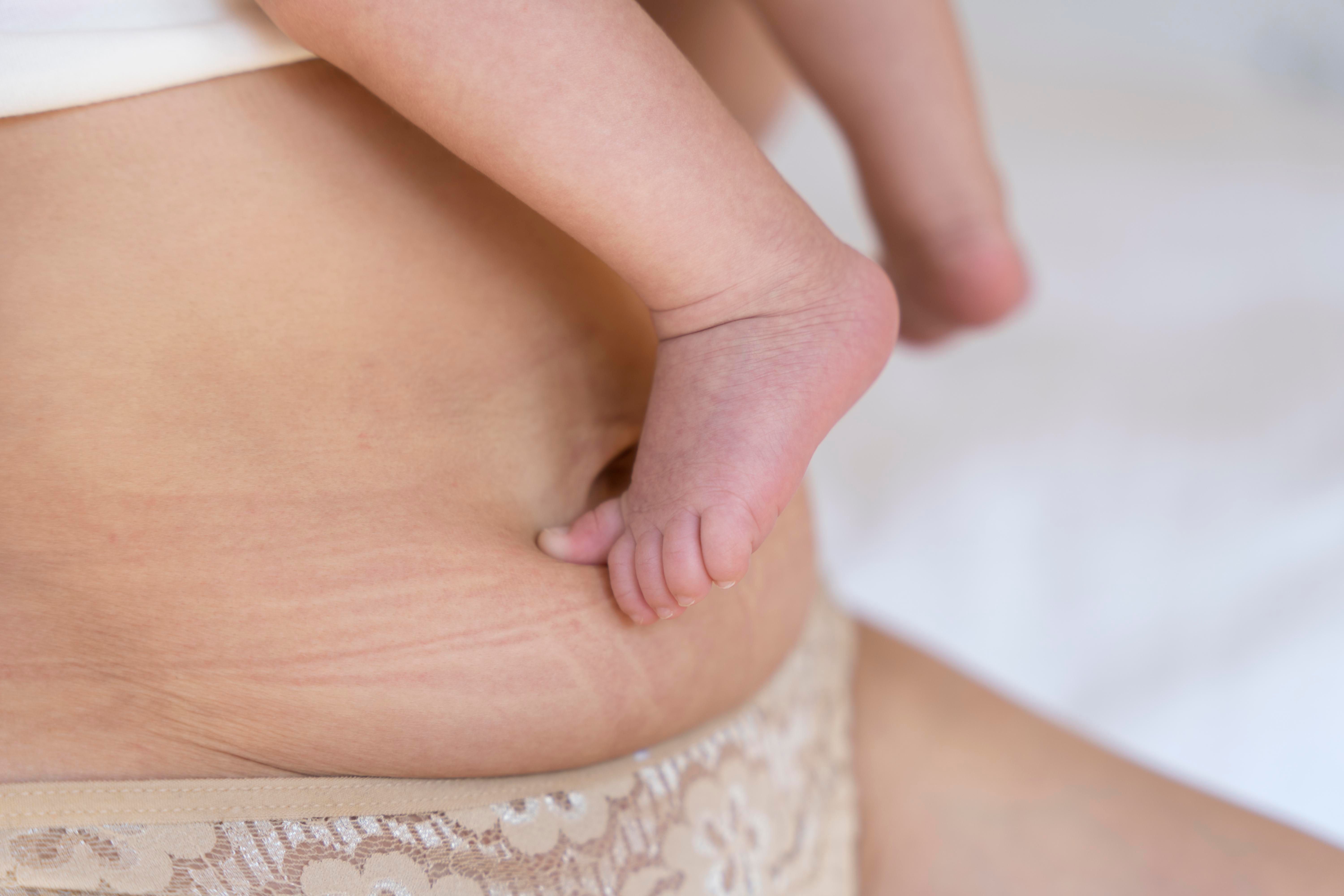 Post Natal Slimming | Postnatal Weight Loss