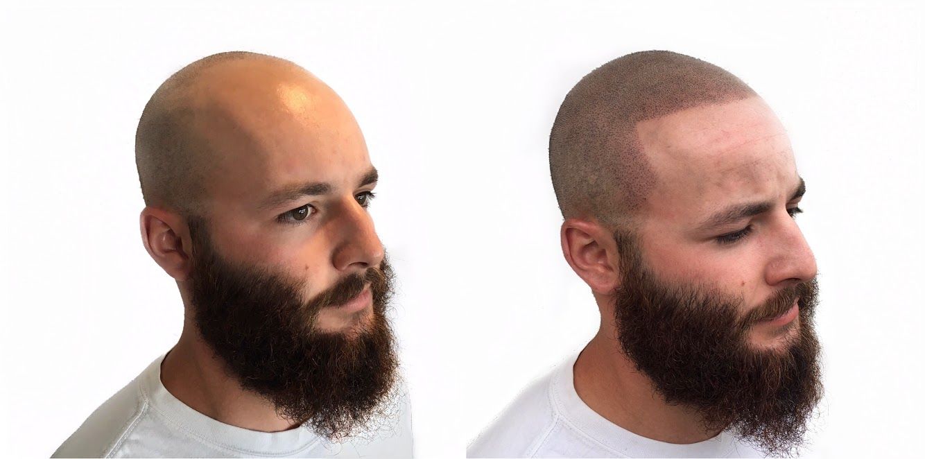 Scalp Micropigmentation Treatment  Cost  What is Scalp Micropigmentation   DHI India
