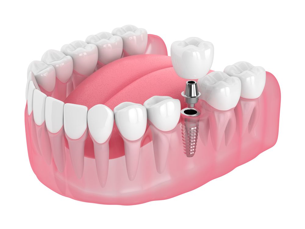 Dental implant procedure