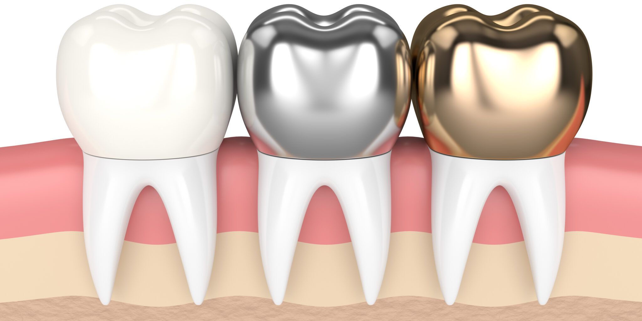 Dental Crown Benefits