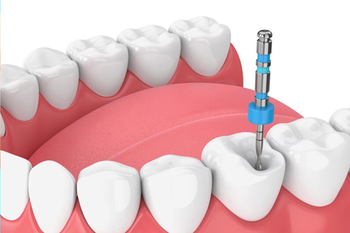 How Long Does a Root Canal Take to Heal