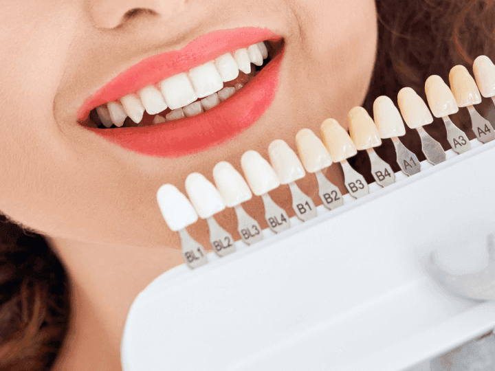 Unlock dazzling smile transformation with Non-Prep Veneers wow
