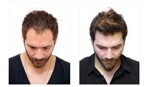 Best Hair Transplant Centers in Dubai: Innovative Techniques