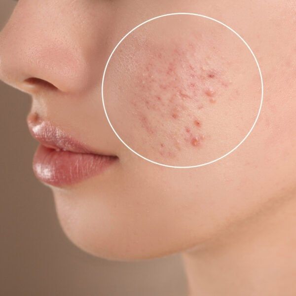Acne Scar Treatment for Sensitive Skin Types