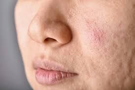 Acne Treatment Success You Need to See
