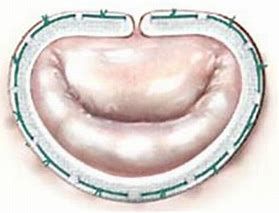 Annuloplasty Rings Market Size, Growth & Forecast Report to 2028
