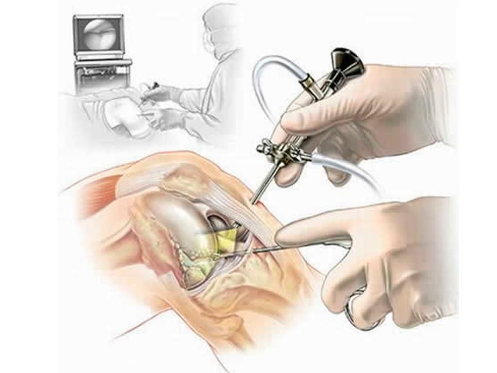 Arthroscopy Devices Market Demand Analysis and Projected Huge