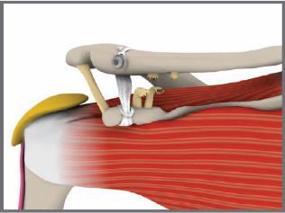 Artificial Ligaments Market 2022: Covid-19 Impact Analysis Report