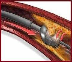 Global Atherectomy Devices Market Forecast Report, 2028
