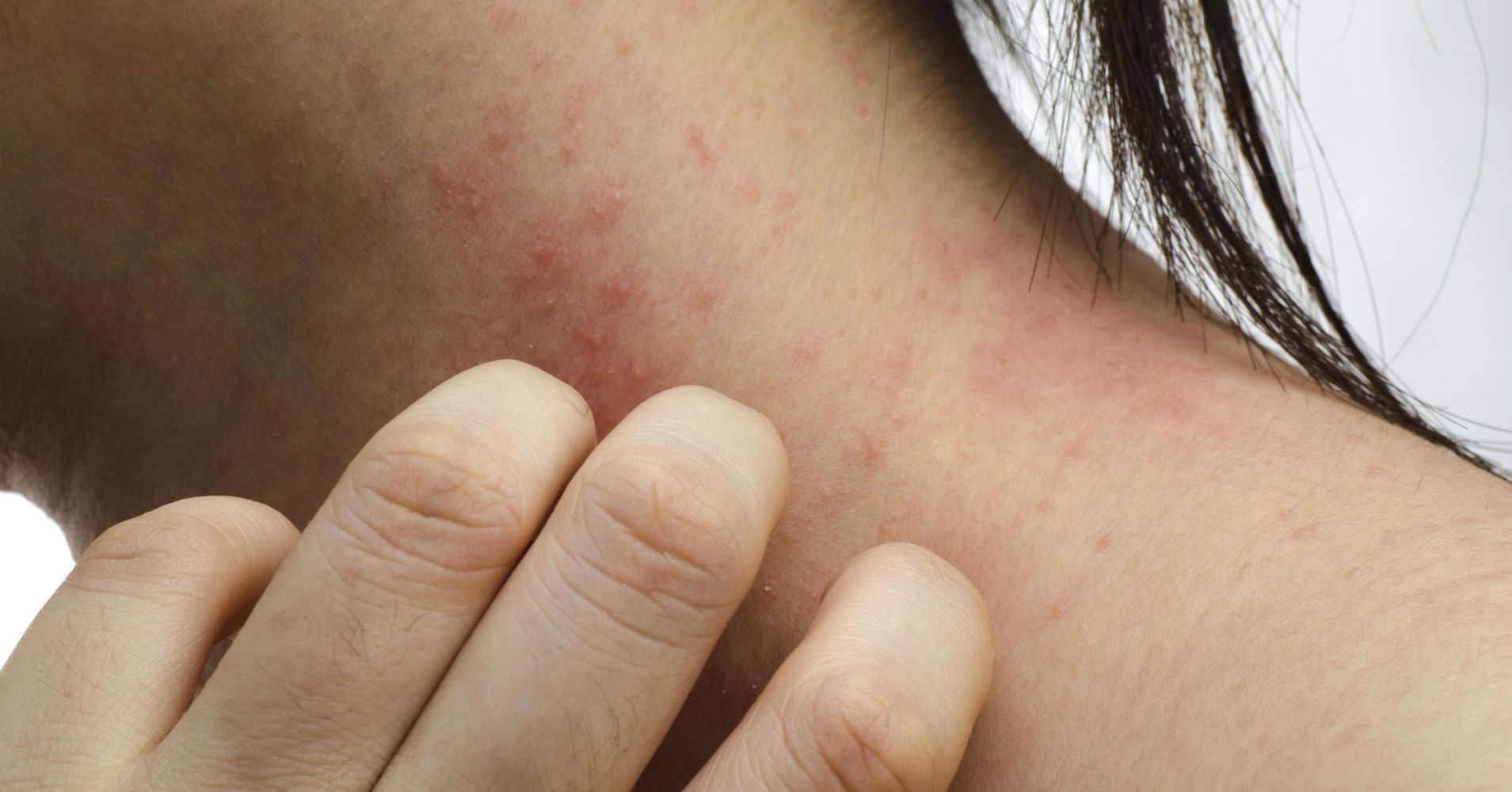 Atopic Dermatitis Treatment Market Overview: Industry Forecast 