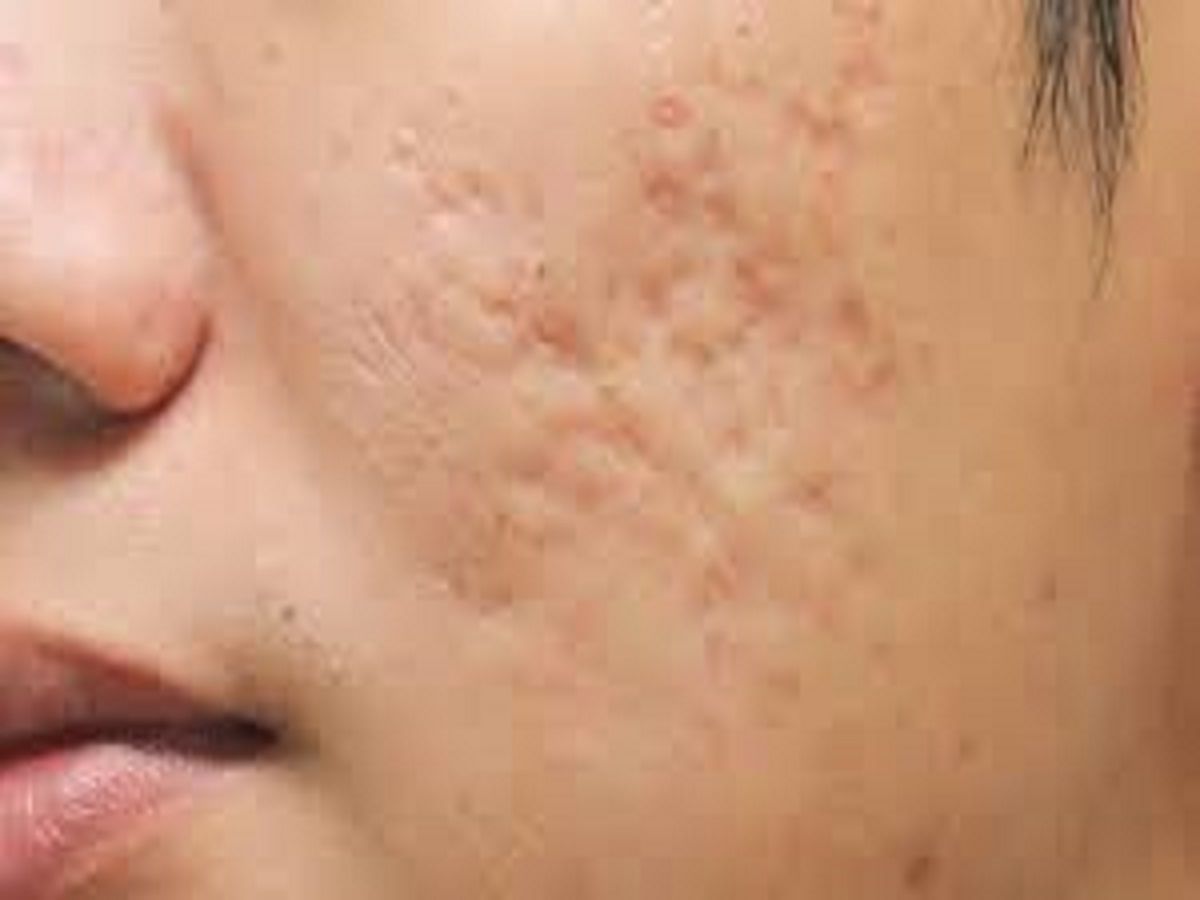 Atrophic Scar Treatment Market Insights and Forecast to 2028
