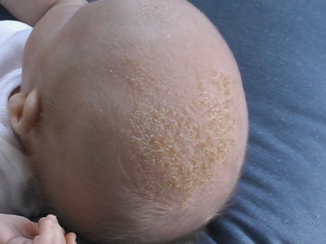 Flaky Scalp in Infants