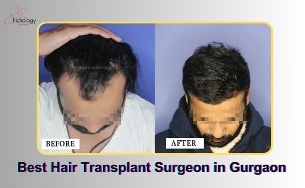 What Should You Ask Your Hair Transplant Surgeon Before Committing To