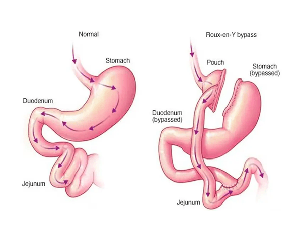 Laparoscopic Sleeve Gastrectomy
