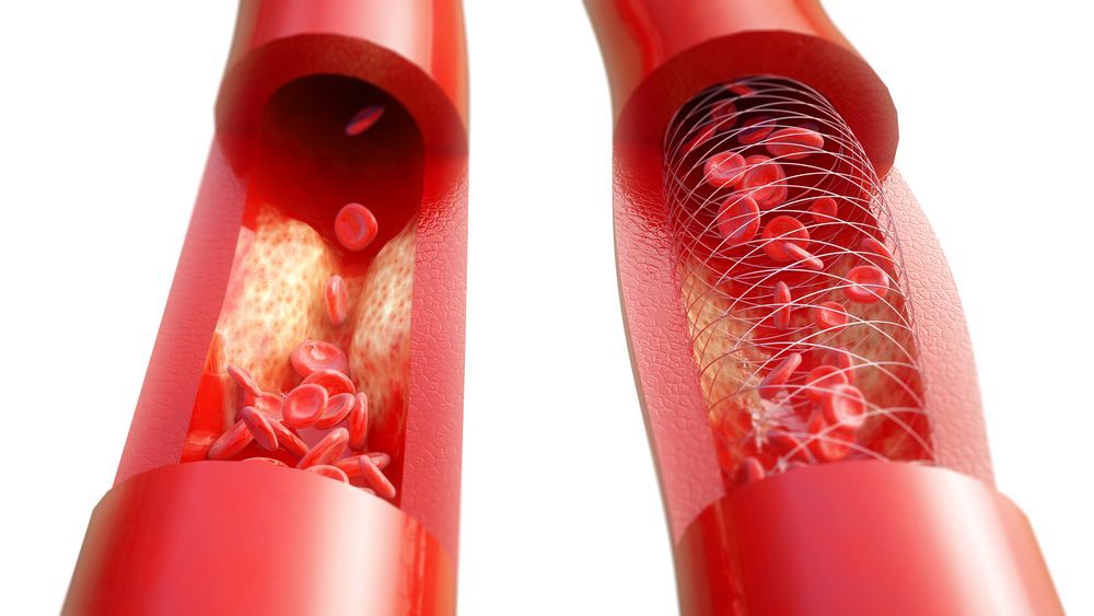 Bioresorbable Vascular Scaffold Market 2022 Dynamics & Forecast