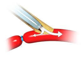 Blood Vessel Prosthesis Market: Global Industry Analysis 