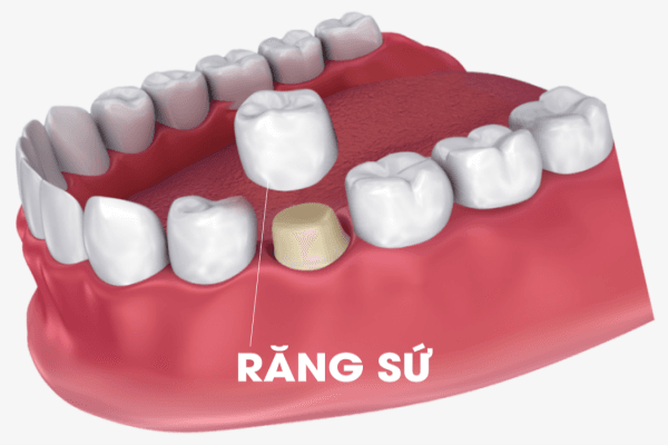 Bọc răng sứ bị lệch khớp cắn – Nguyên nhân, hậu quả và cách xử lý đúng cách