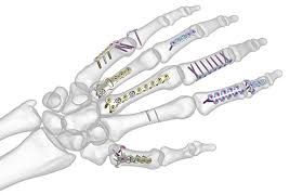 Bone Fixation Plate Market Industry Analysis Till 2028
