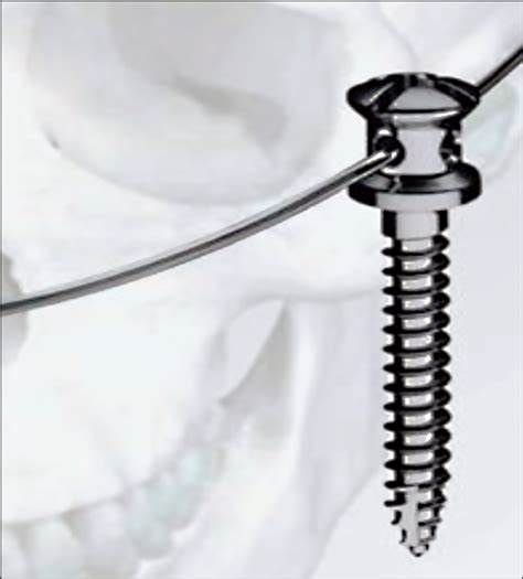 Bone Screw System Market Report 2021-2028