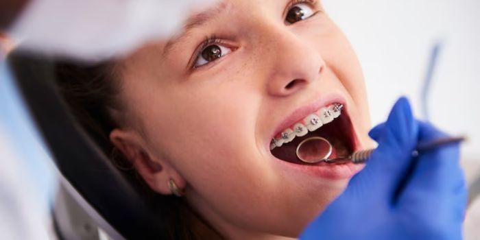 Braces Treatment in Delhi: Start Your Journey to a Confident Smile
