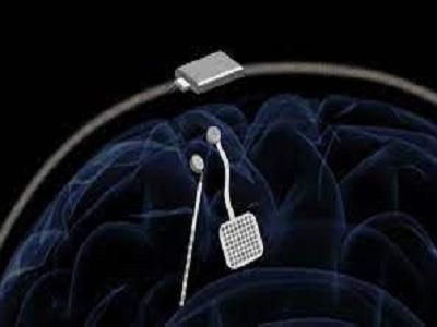 Brain Pacemaker Market: Analysis, Size, Share, Growth 2030