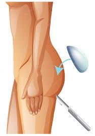 Buttock Augmentation Market Industry Forecast Report, 2028
