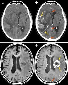 Ct Contrast Media Market Size, In-Depth Analysis Report 2028
