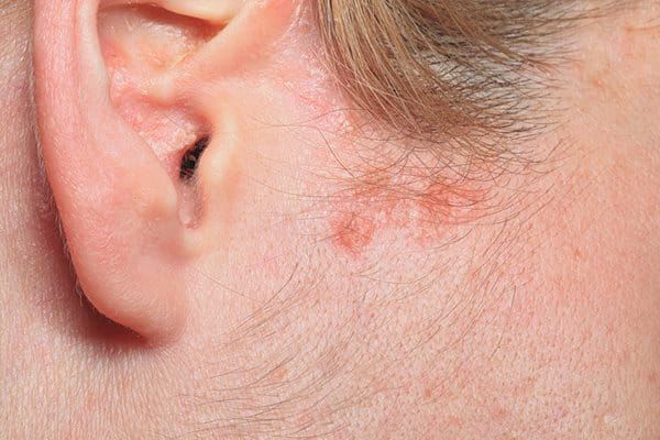 Can a dermatologist treat scalp eczema without steroids