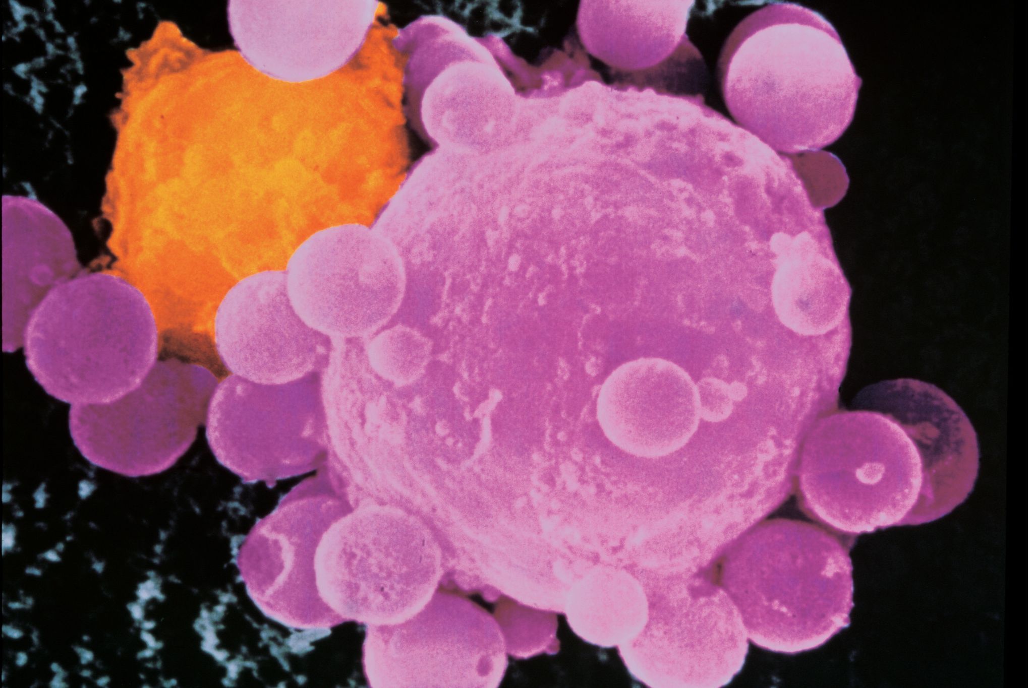 Cancer Cachexia Market Research Report | Forecast to 2028