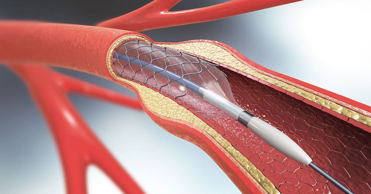 Carotid Artery Stents Market 2022 Dynamics & Forecast Report 2028