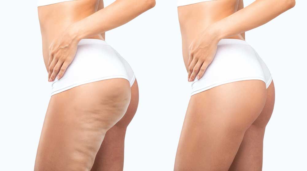 DIY vs. Professional Cellulite Treatment: Navigating Islamabad's Best Options for Smoother Skin