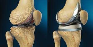 Cementless Total Knee Arthroplasty Market Forecast Report
