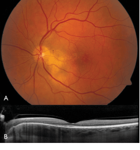 Choroidal Neovascularization Market Report, 2022-2028 | Growth