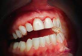 Chronic Gingivostomatitis Treatment Market Analysis Till 2028
