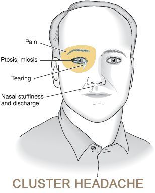 Cluster Headache Syndrome Market Research Report 2028